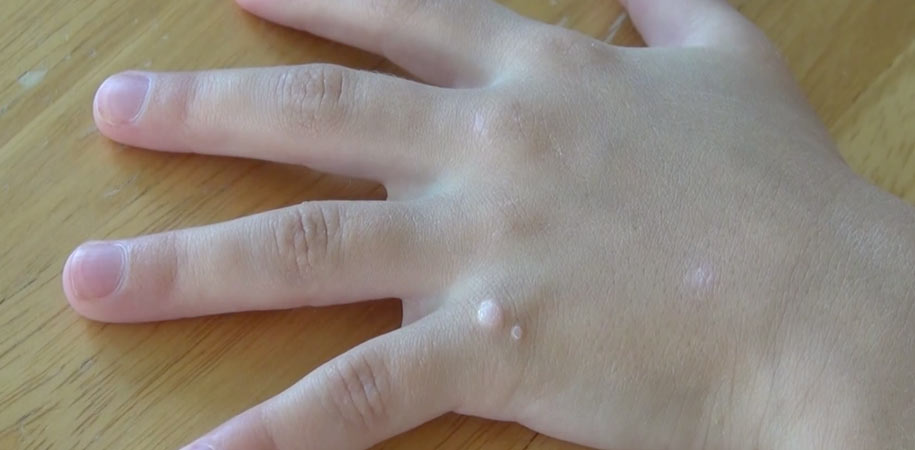 how-to-remove-warts-at-home-1